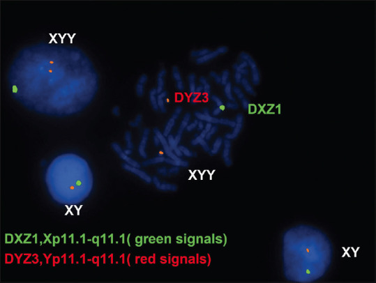 The Use of Fluorescence <i>In situ</i> Hybridisation in the Diagnosis of Hidden Mosaicism in Egyptian Patients with Turner Syndrome.