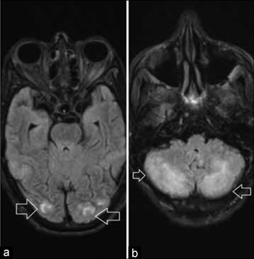 Posterior reversible encephalopathy syndrome secondary to malignancy-associated hypercalcemia: A case report.