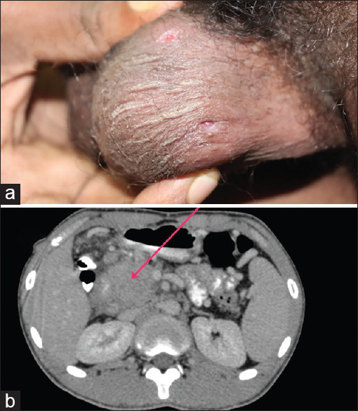 Synchronous pancreatic and scrotal tuberculosis: Double jeopardy.