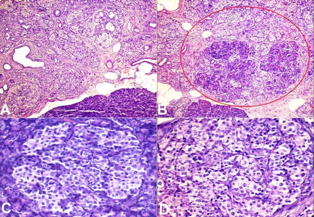 Non-insulinoma pancreatogenous hypoglycemia syndrome (NIPHS)/Nesidioblastosis as the underlying cause of recurrent hypoglycemia in a diabetic adult.