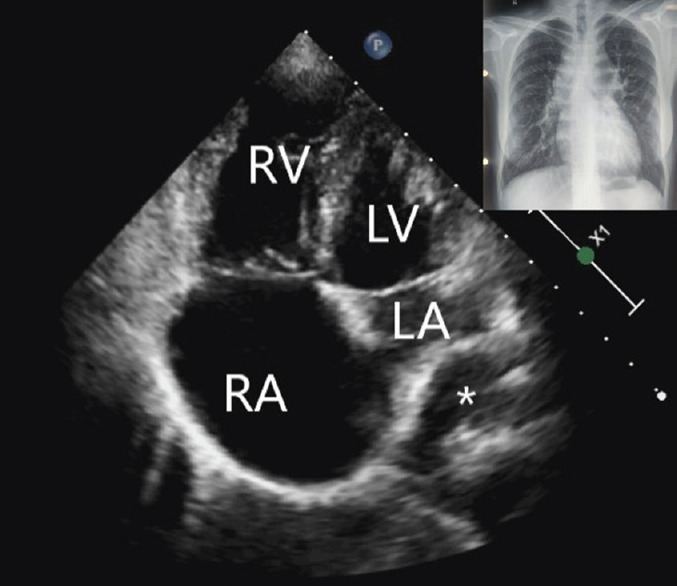 A Case of Late Presentation of Supracardiac Total Anomalous Pulmonary Venous Connection in an Adult.