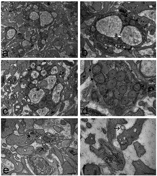 Ozone and procaine increase secretion of platelet-derived factors in platelet-rich plasma.