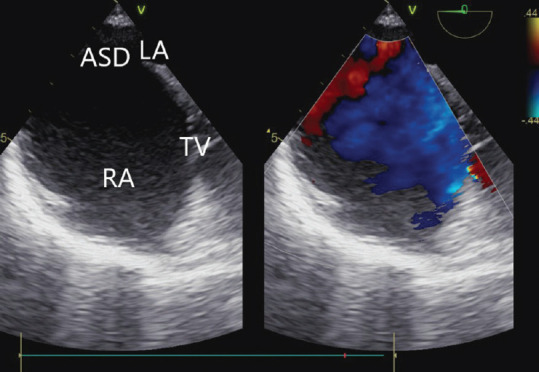A Case of Late Presentation of Supracardiac Total Anomalous Pulmonary Venous Connection in an Adult.