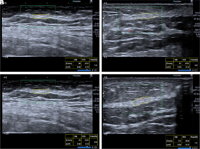 Superb Microvascular Imaging at Evaluation of Nonvisible Buried De-epitelized Flap Vascularization in Breast Reconstruction.