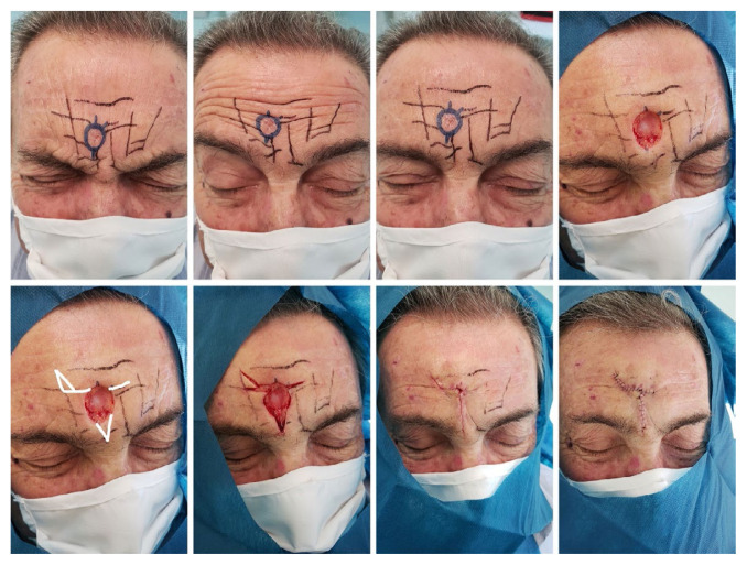 Preoperative Marking to Approximate Forehead Rhytids for Precisely Camouflaging Scars.