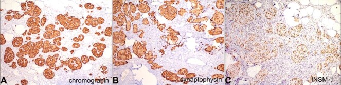 Non-insulinoma pancreatogenous hypoglycemia syndrome (NIPHS)/Nesidioblastosis as the underlying cause of recurrent hypoglycemia in a diabetic adult.