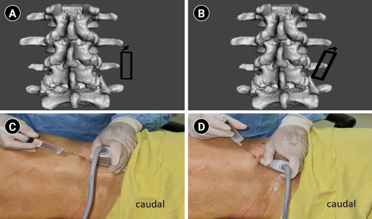 Single puncture combined lumbar erector spinae plane and quadratus lumborum block (SEQ block) in acetabular fracture surgeries: randomized clinical trial.