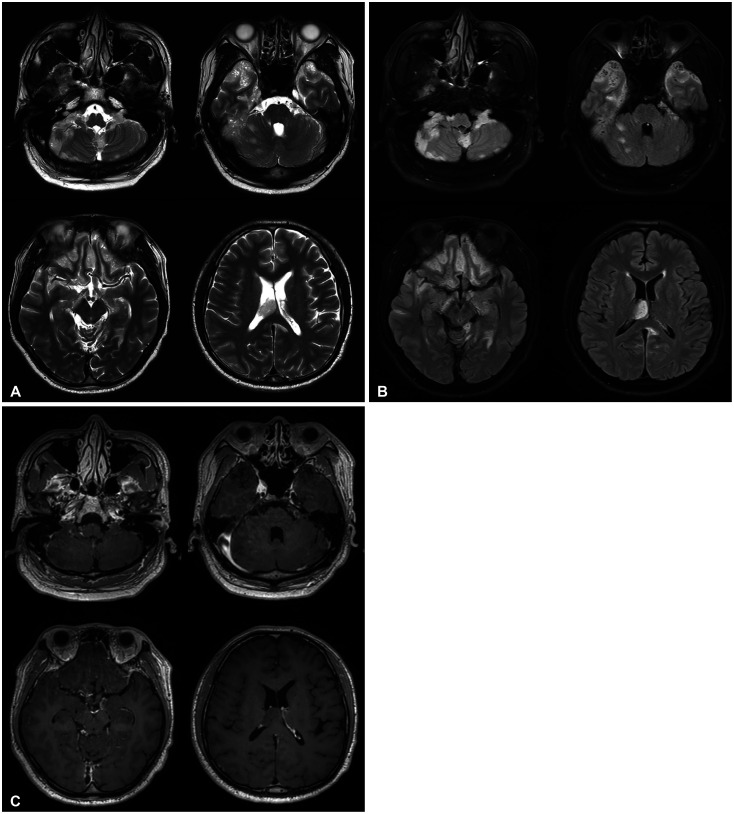 Extensive Leptomeningeal Spreading of Ependymoma in an Adult: Case Report and Literature Review.
