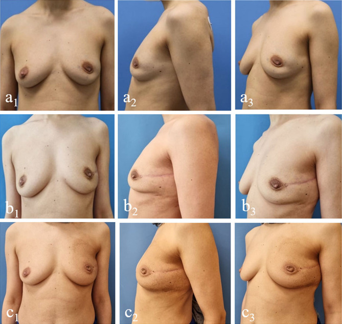 Superb Microvascular Imaging at Evaluation of Nonvisible Buried De-epitelized Flap Vascularization in Breast Reconstruction.
