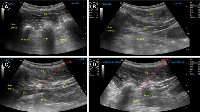 Single puncture combined lumbar erector spinae plane and quadratus lumborum block (SEQ block) in acetabular fracture surgeries: randomized clinical trial.