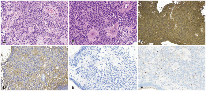 Extensive Leptomeningeal Spreading of Ependymoma in an Adult: Case Report and Literature Review.