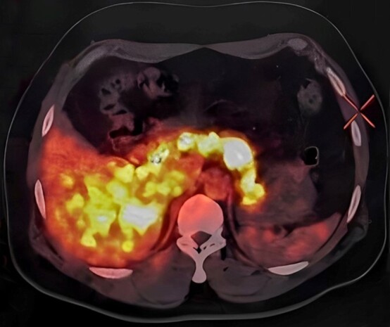 Non-insulinoma pancreatogenous hypoglycemia syndrome (NIPHS)/Nesidioblastosis as the underlying cause of recurrent hypoglycemia in a diabetic adult.