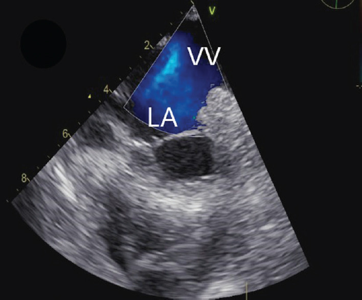 A Case of Late Presentation of Supracardiac Total Anomalous Pulmonary Venous Connection in an Adult.