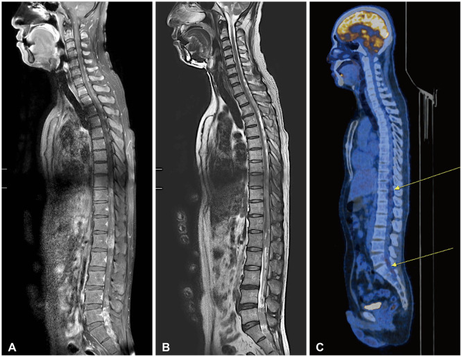 Extensive Leptomeningeal Spreading of Ependymoma in an Adult: Case Report and Literature Review.