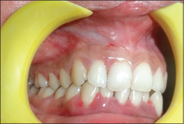 Treatment of aggressive periodontitis in a patient with systemic lupus erythematosus: A case report with 8 years follow-up.