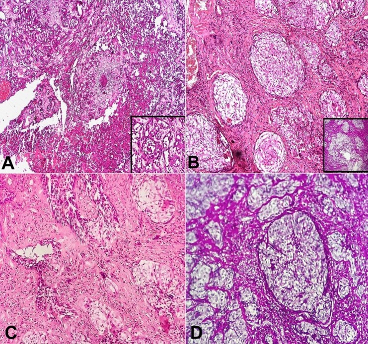 Acantholytic oral squamous cell carcinoma with clear cell change - a rare amalgamated variant.