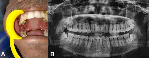 Acantholytic oral squamous cell carcinoma with clear cell change - a rare amalgamated variant.