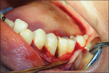 Treatment of aggressive periodontitis in a patient with systemic lupus erythematosus: A case report with 8 years follow-up.