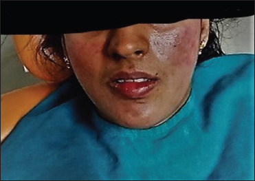 Treatment of aggressive periodontitis in a patient with systemic lupus erythematosus: A case report with 8 years follow-up.