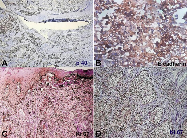 Acantholytic oral squamous cell carcinoma with clear cell change - a rare amalgamated variant.