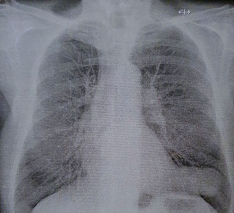 Symptomatic pericardial cysts and dilemmas in their diagnosis.