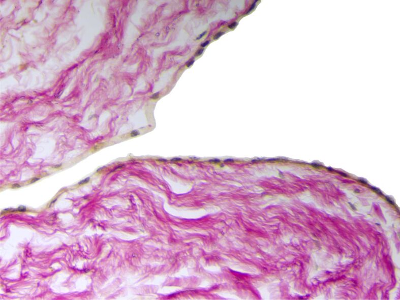 Symptomatic pericardial cysts and dilemmas in their diagnosis.