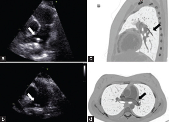 Catch the Cath or Not? A Hamletic Dilemma after 10 Years.