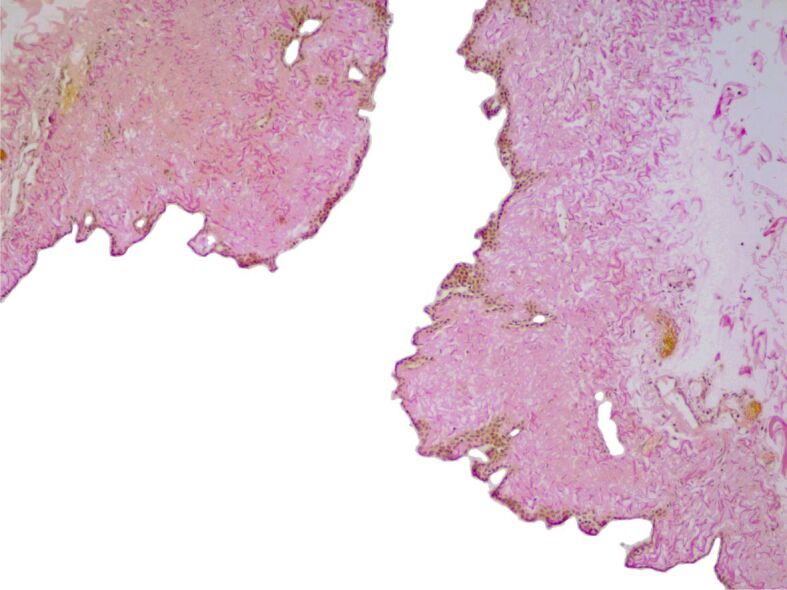 Symptomatic pericardial cysts and dilemmas in their diagnosis.