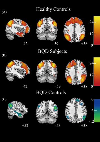 Executive function deficit in betel quid-dependence: Evidence from functional and effective connectivity of executive control network