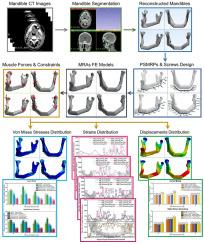 Biomechanical feasibility of non-locking system in patient-specific mandibular reconstruction using fibular free flaps