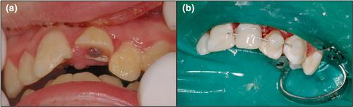 Indications for root canal treatment following traumatic dental injuries to permanent teeth