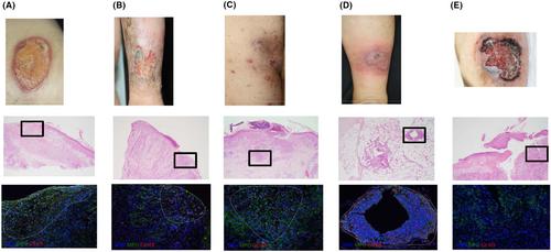 The presence of neutrophil extracellular traps in different forms of pyoderma gangrenosum