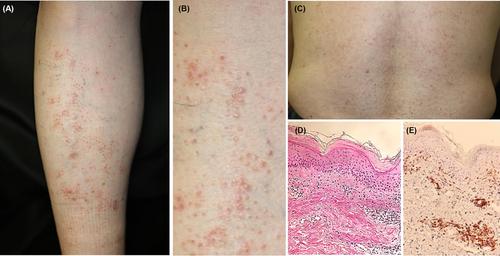 Pityriasis rubra pilaris following administration of SARS-CoV-2 vaccine