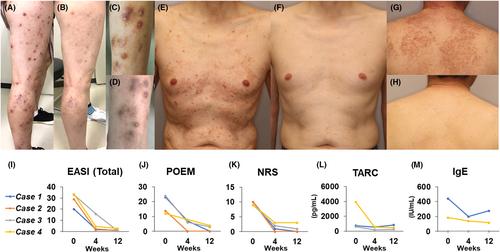 Effectiveness of upadacitinib in Japanese patients with prurigo-type atopic dermatitis: Four cases report