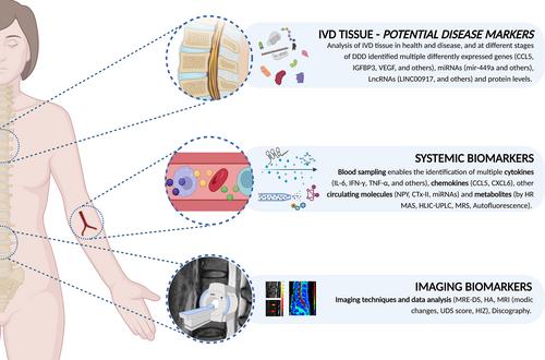 Biomarkers for intervertebral disc and associated back pain: From diagnosis to disease prognosis and personalized treatment