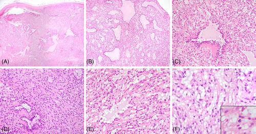 Myxoid epithelioid smooth muscle tumor of the vulva: A distinct entity with MEF2D::NCOA2 gene fusion