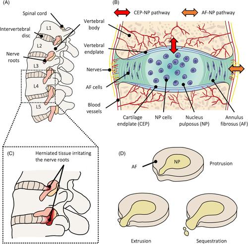 Understanding the etiopathogenesis of lumbar intervertebral disc herniation: From clinical evidence to basic scientific research