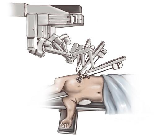 Uniportal robotic assisted surgery for anatomical lung resection—First German experience