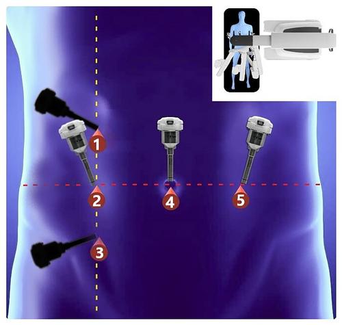 Dual docking technique for robotic repair of simultaneous inguinal and umbilical hernia: A preliminary single center experience