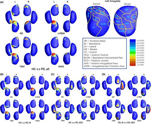 Fine-grained features characterize hippocampal and amygdaloid change pattern in Parkinson's disease and discriminate cognitive-deficit subtype