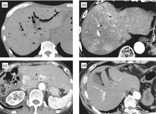 A multi-institutional study designed by members of Tokyo Guidelines (TG) Core Meeting to elucidate the clinical characteristics and pathogenesis of acute cholangitis after bilioenteric anastomosis and biliary stent insertion with a focus on biliary obstruction: Role of transient hepatic attenuation difference (THAD) and pneumobilia in improving TG diagnostic performance