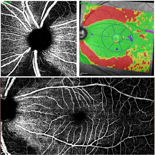 Genetic risk of glaucoma is associated with vascular and retinal nerve fibre wedge defects