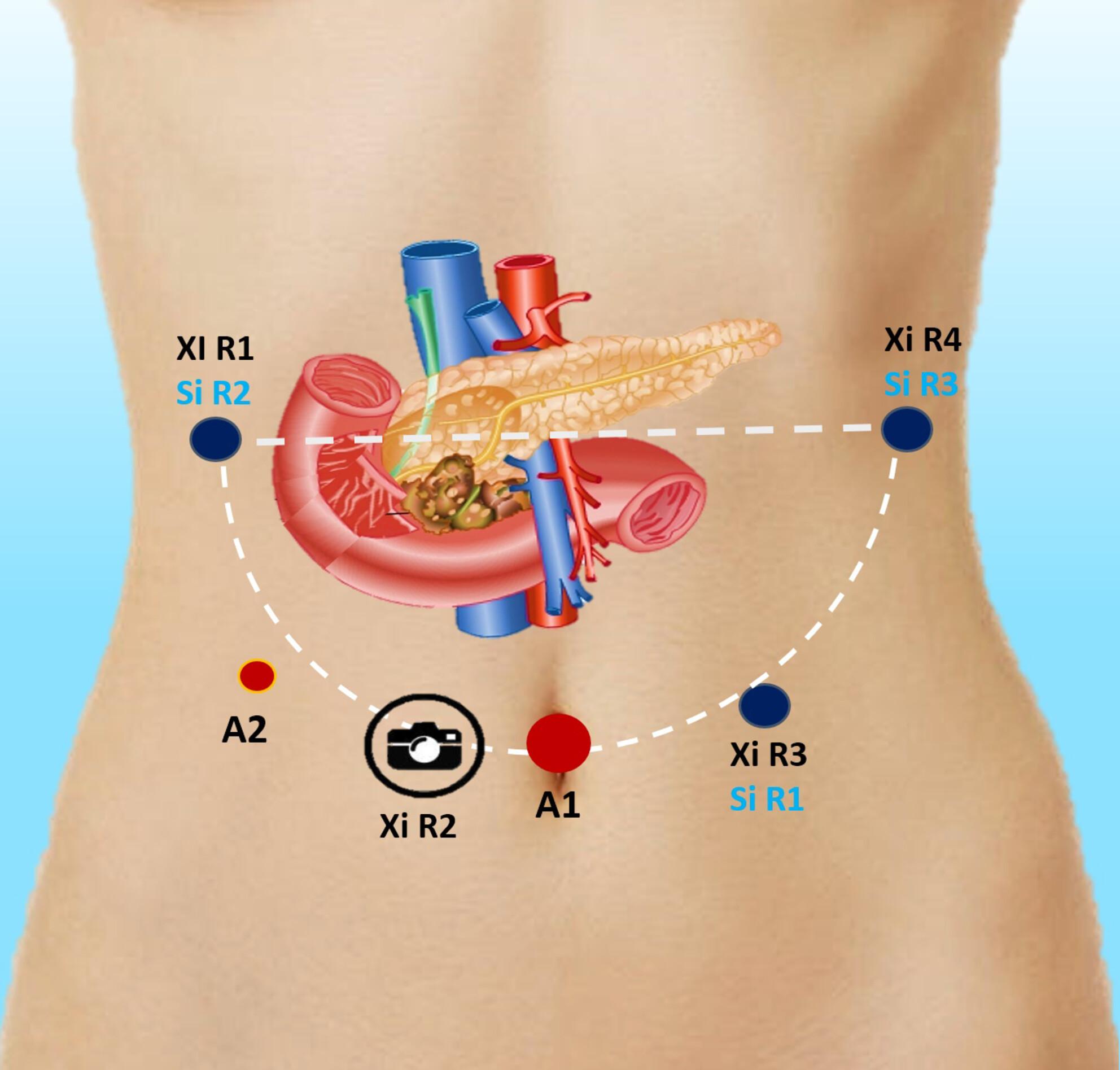 Reappraisal of surgical and survival outcomes of 500 consecutive cases of robotic pancreaticoduodenectomy