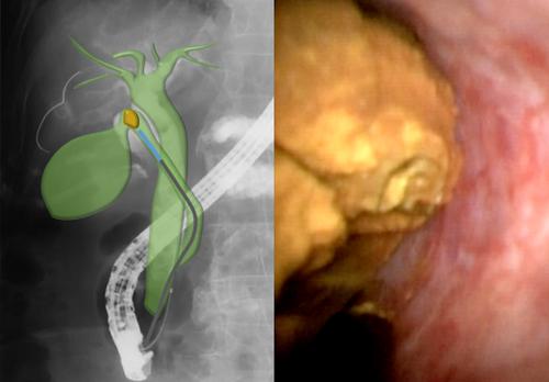 Novel peroral cholangioscopy-guided electrohydraulic lithotripsy for difficult stones