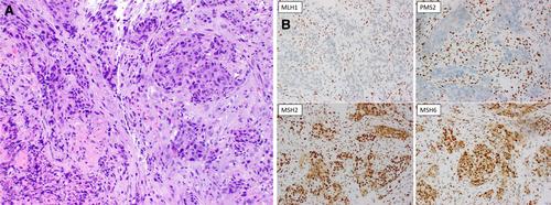 Locally advanced mismatch repair-deficient gastroesophageal junction cancer: Diagnosis, treatment modifications, and monitoring