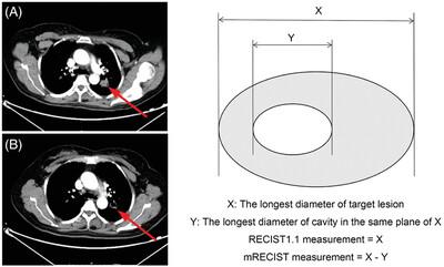 Modified response evaluation criteria in solid tumors: A better response evaluation criteria for patients with non-squamous non-small cell lung cancer after bevacizumab treatment