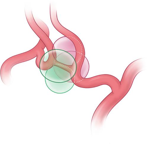 The vanishing of the ACoA syndrome after aneurysmal subarachnoid haemorrhage: New era, different management, fewer problems?