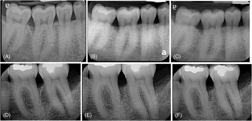 A comparison of Er,Cr:YSGG laser to minimally invasive surgical technique in the treatment of intrabony defects: Twelve-month results of a multicenter, randomized, controlled study