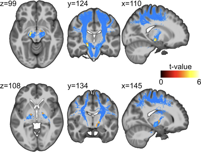 Changes in brain structure in subjects with resistance to thyroid hormone due to THRB mutations.