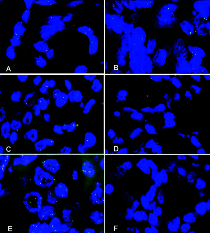 Molecular Detection of <i>FGFR2</i> Rearrangements in Resected Intrahepatic Cholangiocarcinomas: FISH Could Be An Ideal Method in Patients with Histological Small Duct Subtype.